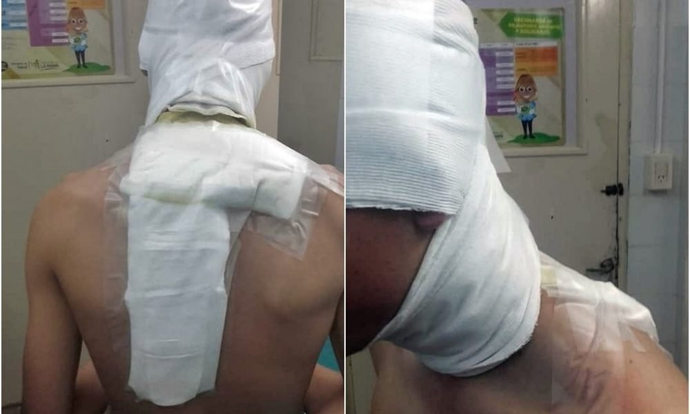 ¡Locura en el fútbol pampeano! Quemaron a un juvenil con agua hirviendo